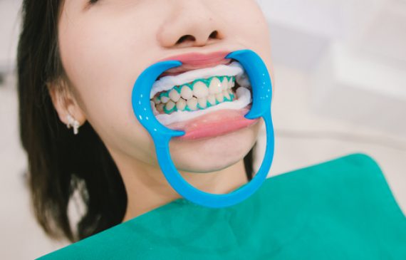 טיפולי שיניים אסתטיים בעידן המודרני